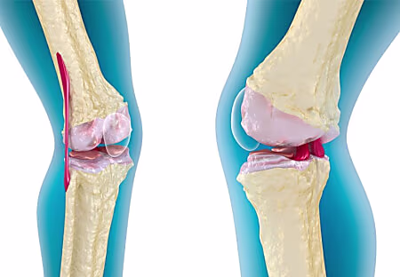 خدعة بسيطة لعلاج المفاصل في شهر واحد! سيختفي الألم في 40 دقيقة.. مذهل خدعة بسيطة لعلاج المفاصل في شهر واحد! سيختفي الألم في 40 دقيقة.. مذهل