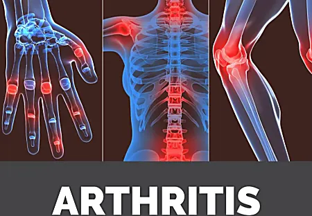 Suffering From Arthritis and Joint Pain? Try This India Formula Today Suffering From Arthritis and Joint Pain? Try This India Formula Today