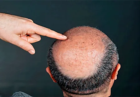 This Trick Can Fight Hair Loss In 3 Days