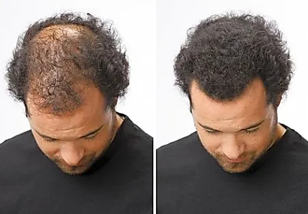 This Trick Can Fight Hair Loss In 3 Days